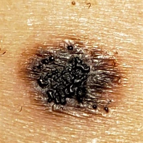 crusty mole melanoma pictures